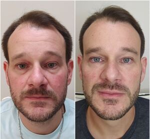 Bioestimuladores de colágeno para rejuvenescimento e firmeza da pele em Curitiba Cabral - tratamento anti-idade avançado