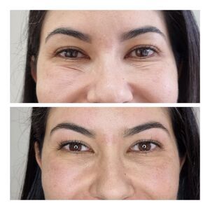 Tratamento com Fios de PDO