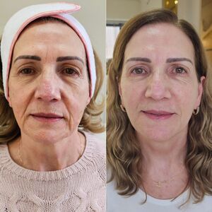HIFU ultrassom microfocado para lifting facial não invasivo em Curitiba Cabral - rejuvenescimento sem cirurgia