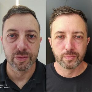 Preenchimento facial com ácido hialurônico para volume e hidratação da pele em Curitiba - gerenciamento do envelhecimento natural